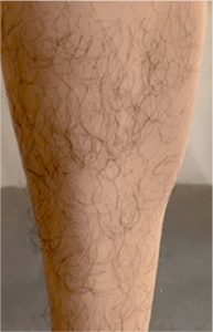 Leg