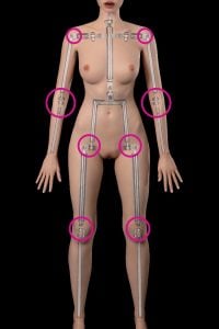 Limb Loose Joints-No Standing Ability