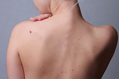 Moles on body