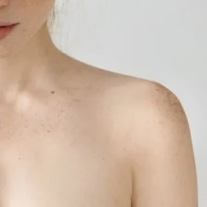Body Freckle