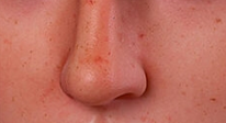 Freckles